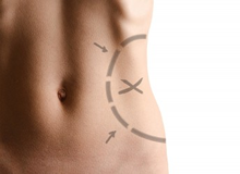 Tummy Tuck Toronto (Abdominoplasty)