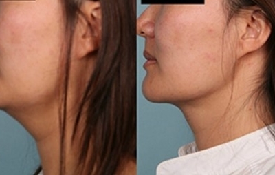 Liposuction Toronto Before & After Photo Rice Cosmetic Surgery